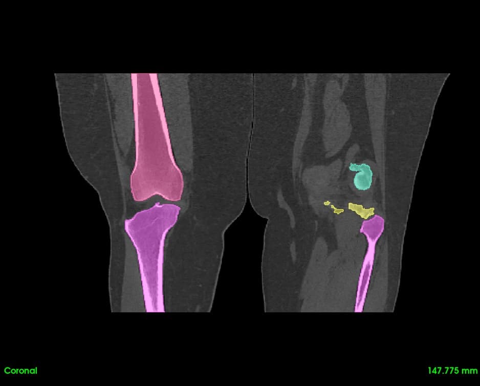 Coronal View with Segmentation