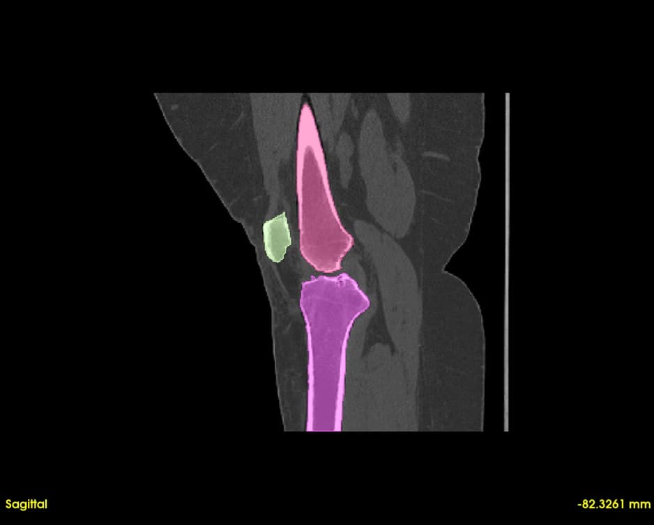 Sagittal View with Segmentation